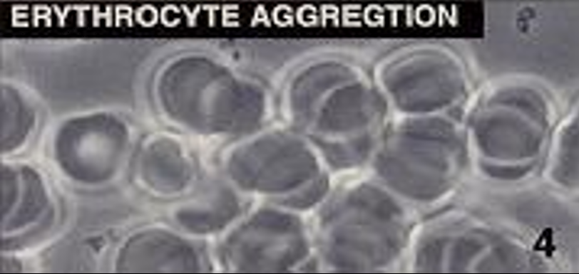 Agrégation des érythrocytes Agrégation des érythrocytes